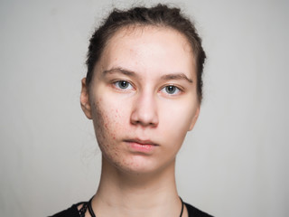 Comparison portrait of a woman with problematic skin without and with makeup