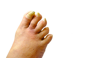 Sick unhealthy nails on the foot of a man isolated