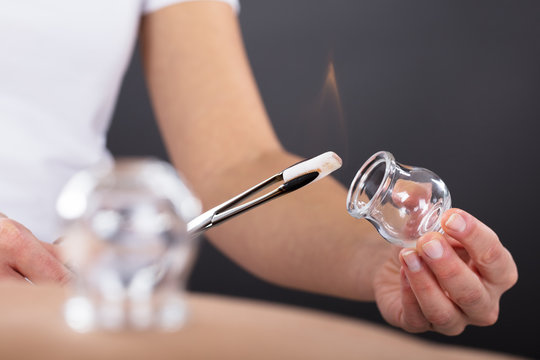 Therapist Giving Cupping Treatment