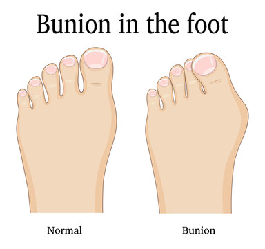 Bunion in the foot