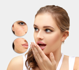 Post-Acne Marks /Treating Acne Scars