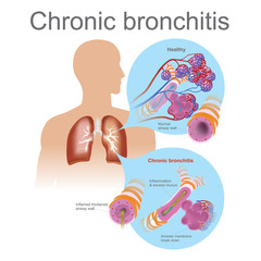 Chronic bronchitis. Acute bronchitis is usually caused by viruses, typically the same viruses that cause colds and flu. - obrazy, fototapety, plakaty