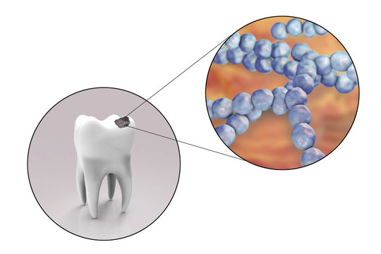 Tooth with dental caries and close-up view of microbes which cause caries Streptococcus mutans, 3D illustration