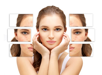 Post-Acne Marks /Treating Acne Scars