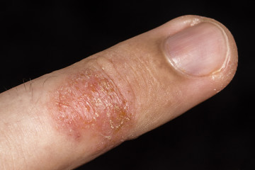 Eczema occurring on fingers.