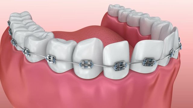 Teeth with braces Alignment process. Medically accurate 3D animation.