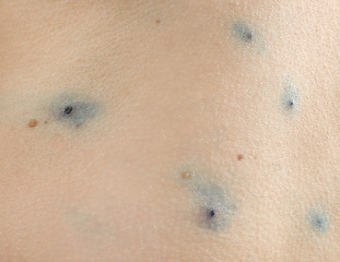 Fototapeta premium Skin of human ill with chicken pox, closeup