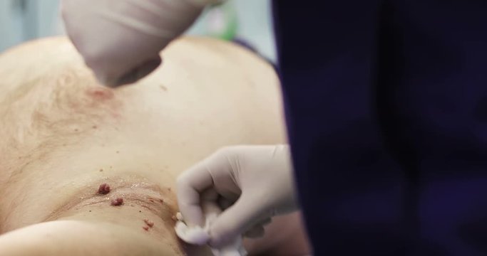 Disinfection before removing of papillomas.