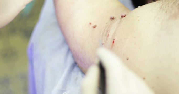 4K Close up. Electrocoagulation of papillomas.