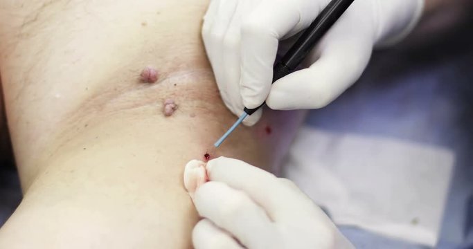 4K Electrocoagulation of papillomas.