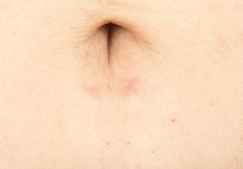 Fototapeta premium Rash in women