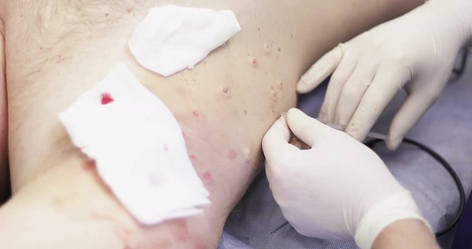 4K Armpits is with papillomas.
