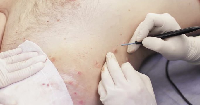 4K Electrocoagulation of papillomas.