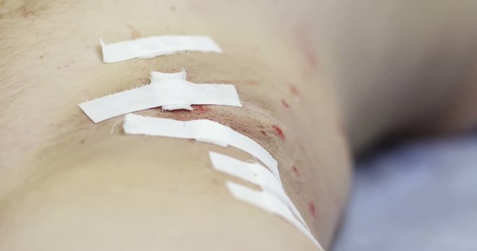 4K The patch is on the wounds.