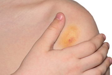 Fototapeta premium ?hild holds his hand over his shoulder on which there is a bruise.