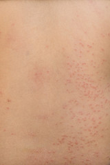 detail of rash on back from allergy