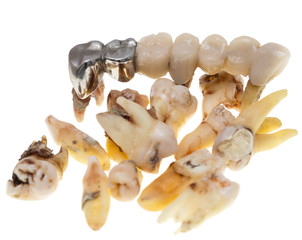 Patients extracted teeth on a white background