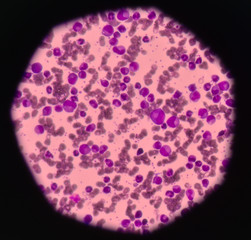 Leukemia blood cells medical science background concept.