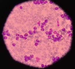Leukemia blood cells medical science background concept.