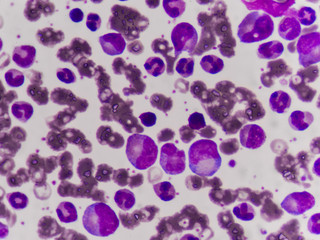 Leukemia blood cells medical science background concept.