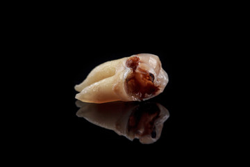 The remote tooth is damaged by caries on a black background. Macro.
