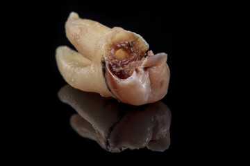 The remote tooth is damaged by caries on a black background. Macro.