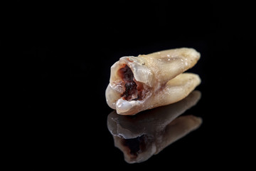 The remote tooth is damaged by caries on a black background. Macro.