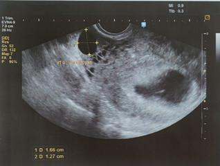 ultrasound of a fetus at 7 weeks 5 Days,sound or other vibrations having an ultrasonic frequency, particularly as used in medical imaging especially one of a pregnant woman to examine the fetus.