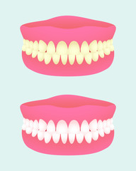 Denture in two health states. Dental implant with different teeth colors. Sick and healthy teeth jaw. Medical items.
