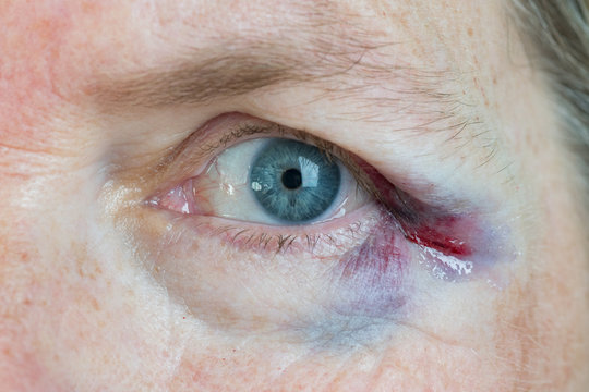 Close up of a bruised eye with a skin laceration repaired with glue