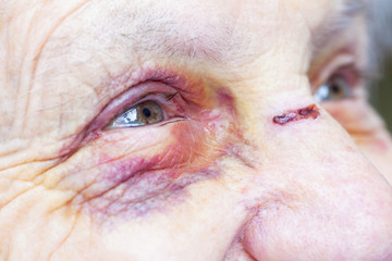 Injured elderly woman