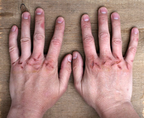 Damaged hands