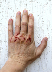 Damaged hands
