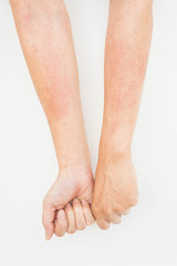 Skin rashes, allergies contact dermatitis ,allergic to chemicals ,fungal infections from exposure