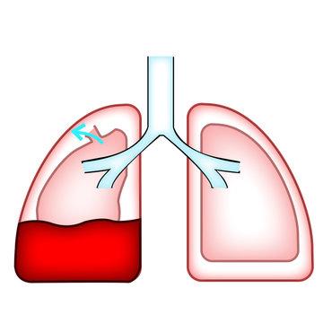 hemothorax lung