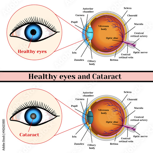 "Healthy eyes and cataract (opacity of the eye lens)." fichier