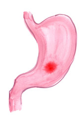 Scheme of human stomach with irritation painted in watercolor on clean white background