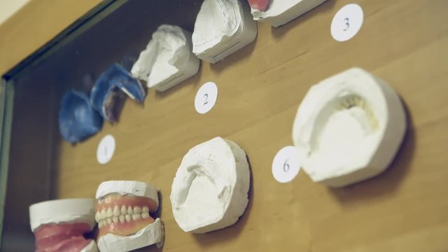 Cast dental models on wooden panel