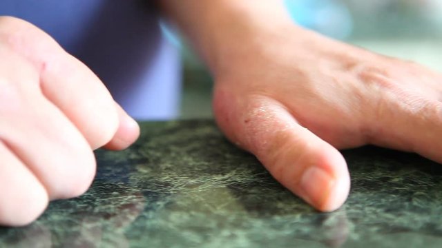 Hands with psoriasis or shingles sickness. Skin problems.