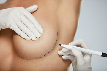 Surgical Lines. Woman Body In White Underwear With Marks On Skin