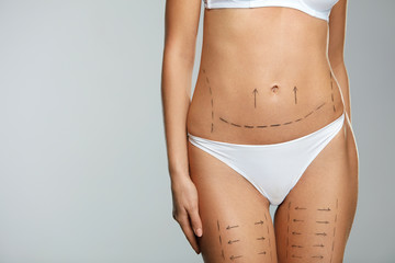 Surgical Lines. Woman Body In White Underwear With Marks On Skin