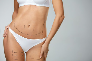 Surgical Lines. Woman Body In White Underwear With Marks On Skin