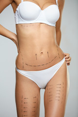 Surgical Lines. Woman Body In White Underwear With Marks On Skin