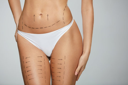 Surgical Lines. Woman Body In White Underwear With Marks On Skin