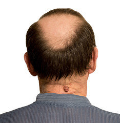 Fototapeta premium A man with alopecia and a mole on his neck