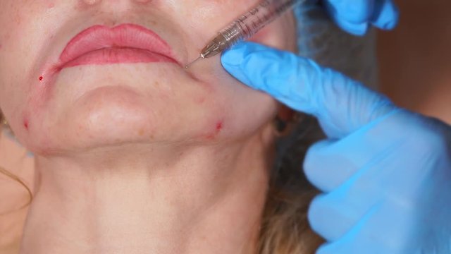 Close up shot of face of a middle-aged woman, where botulinum is injected by the doctor of privat clinic to smooth out facial wrinkles, as well as lip-chin wrinkles