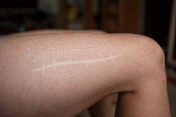 Scar on female leg