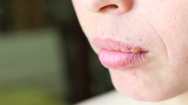 Herpes labialis, also called cold sores among other names, is a type of herpes simplex occurring on the lip, ie an infection caused by herpes simplex virus (HSV)