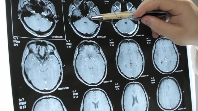 The MRI of the human brain in the doctor's hands