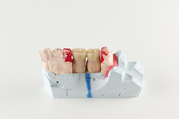 ceramic crowns to try on a tooth model